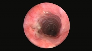 tracheal-stenosis-balloon-treatment-canonical